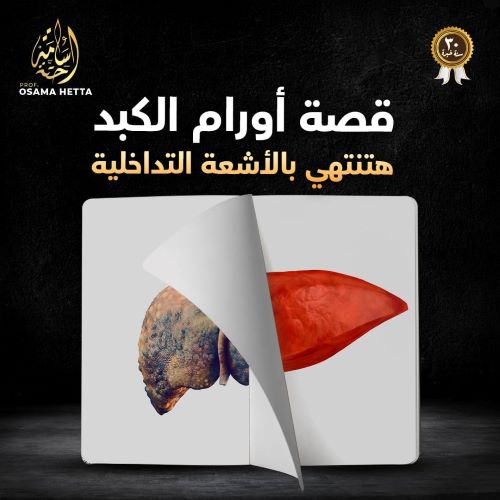 هل يمكن الشفاء من سرطان الكبد
